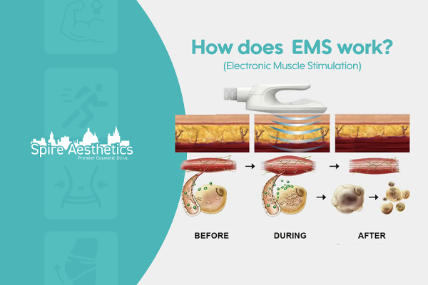 EMS treatment for post pregnancy weight loss treatment Ware
