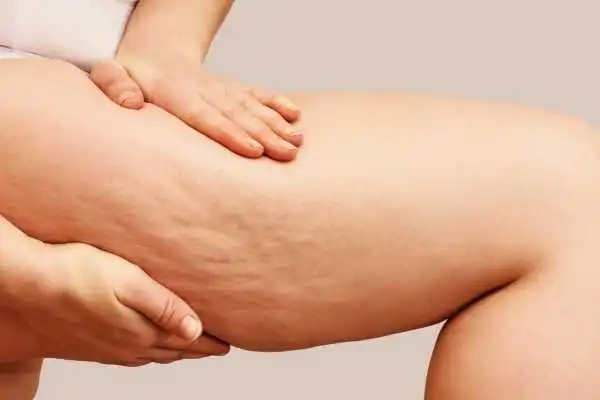 Image of woman showing leg with cellulite Ware