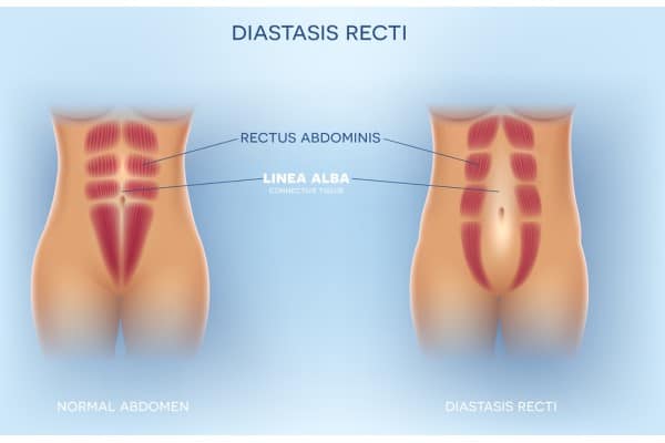 What Non-Surgical Options Are Available for Diastasis Recti Ware?