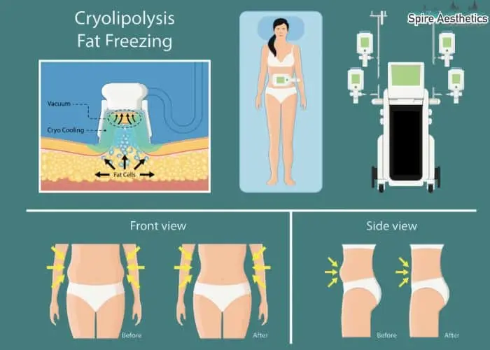 Fat freezing treatment Ware benefits for competitions to remove stubborn fat deposits.
