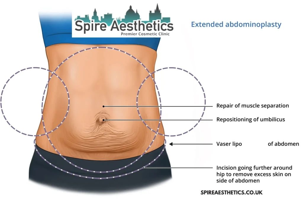 Understanding Loose Skin After Gastric Band Ware Surgery and HIFU Treatment