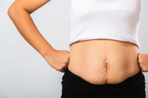 Image of a woman's stomach after weight loss with sagging skin following a gastric band Ware