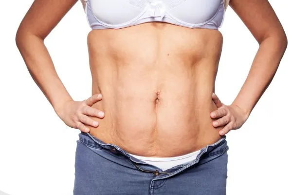 sagging skin on woman's stomach after weight loss injections Ware