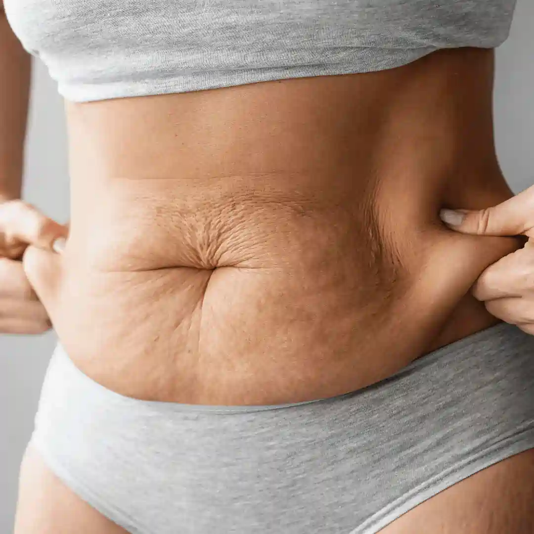 Is It Normal to Have Loose Skin After Pregnancy Ware?