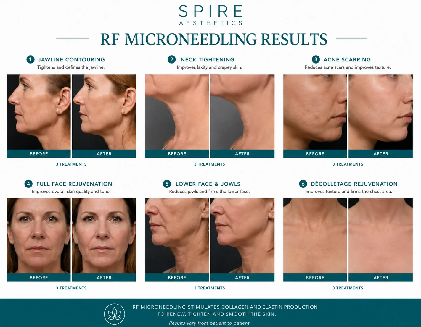 RF Microneedling Skin tightening Ware results
