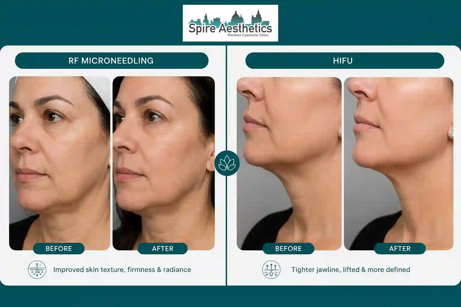 Can RF Microneedling and HIFU Be Combined Ware?